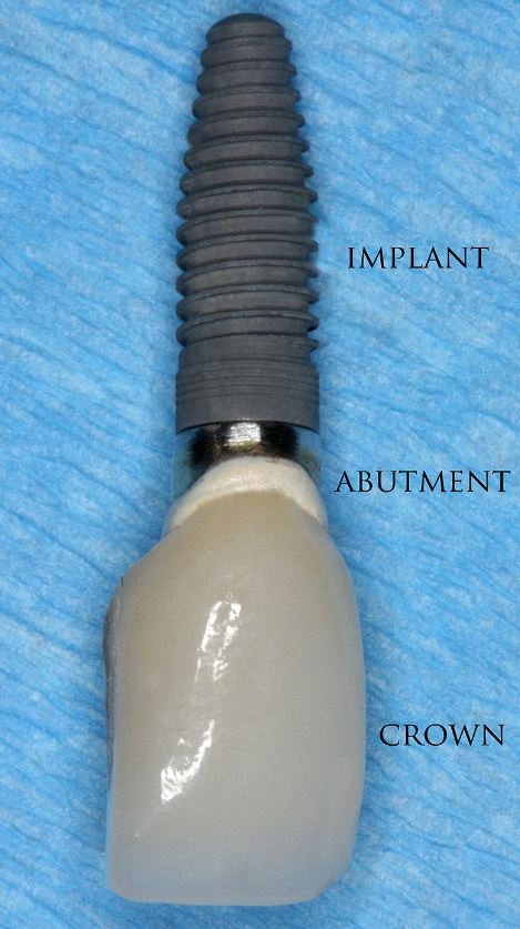 loose dental implants