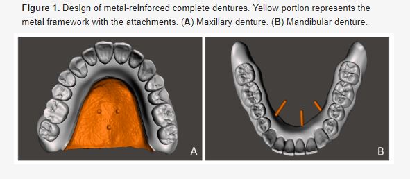 Acrylic vs. Metal dentures